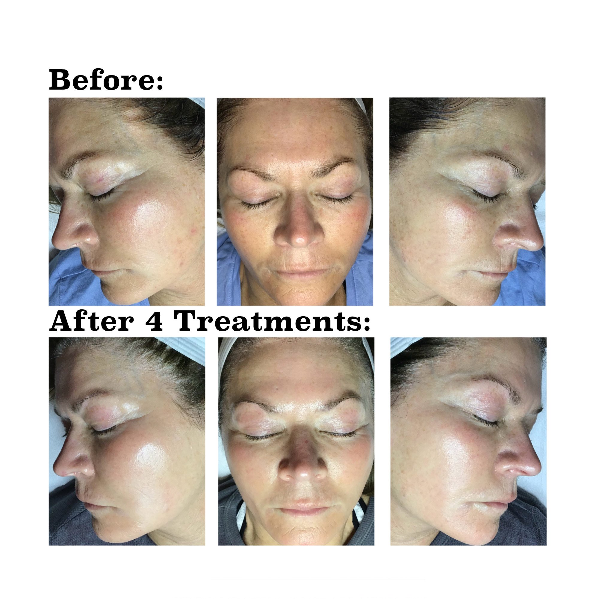 IPL medical spa treatment before and after