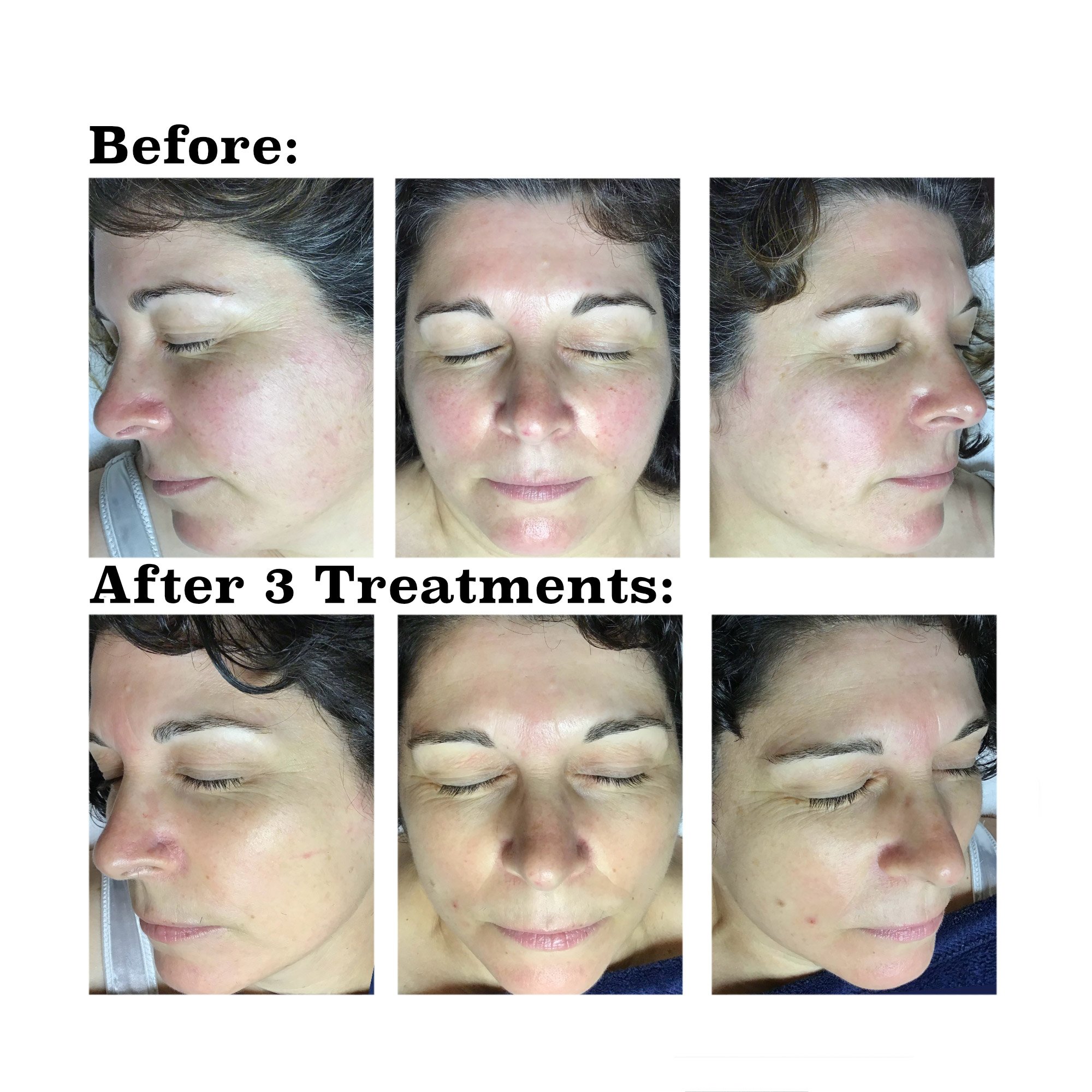 IPL medical spa treatment before and after