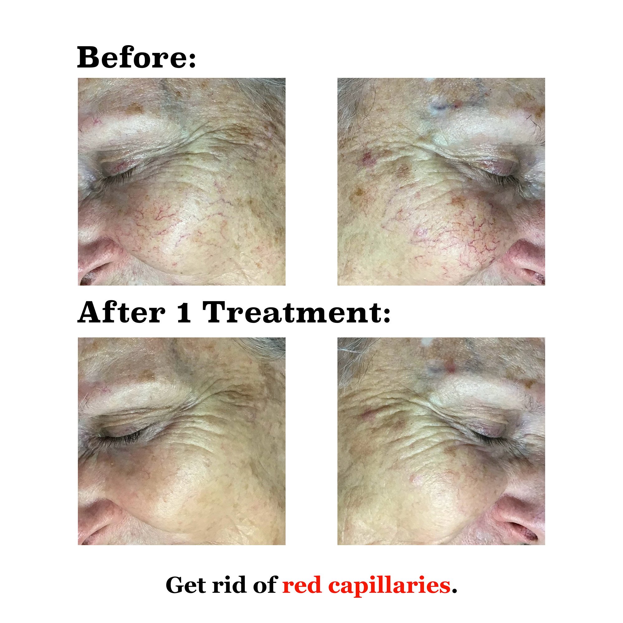 IPL medical spa treatment before and after