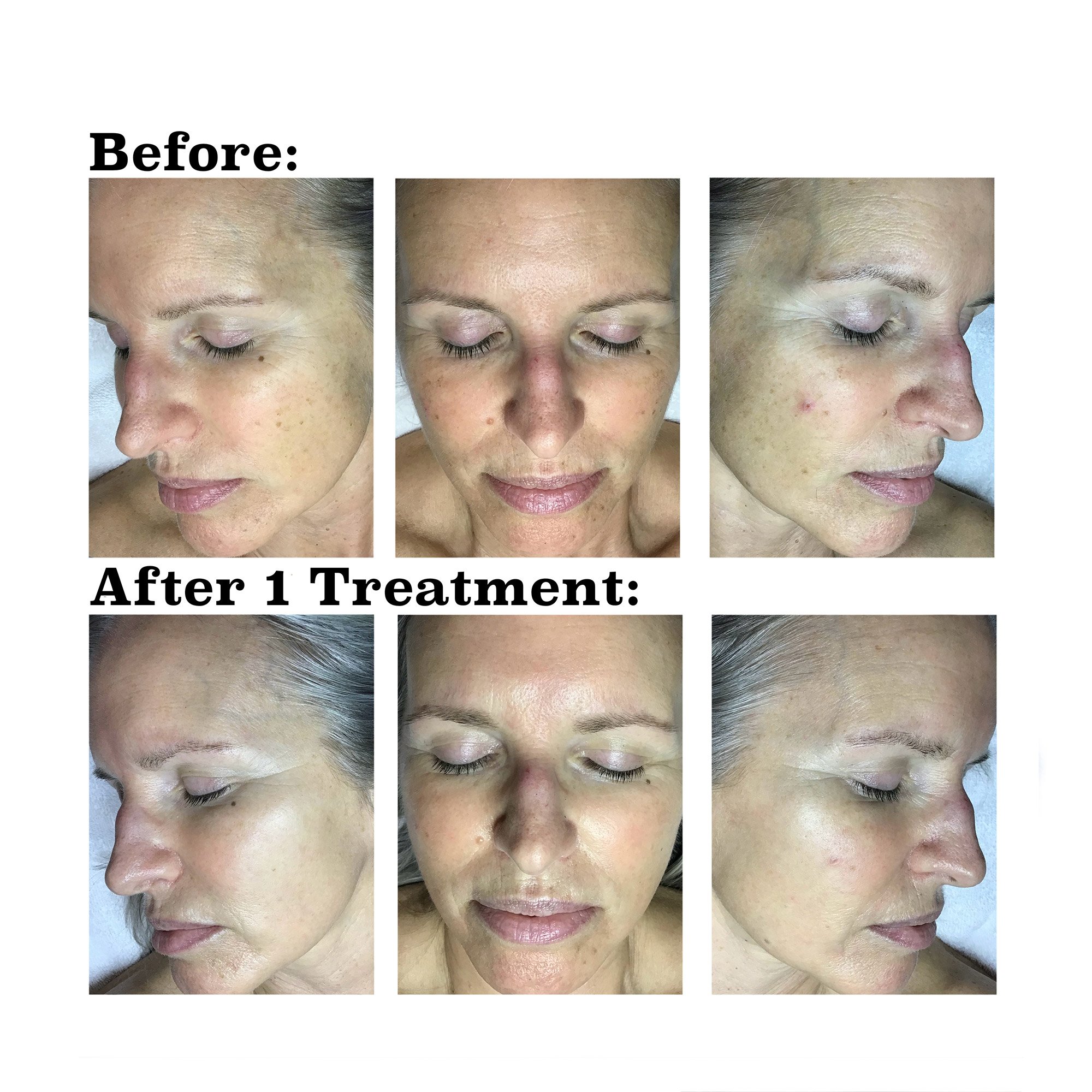 IPL medical spa treatment before and after