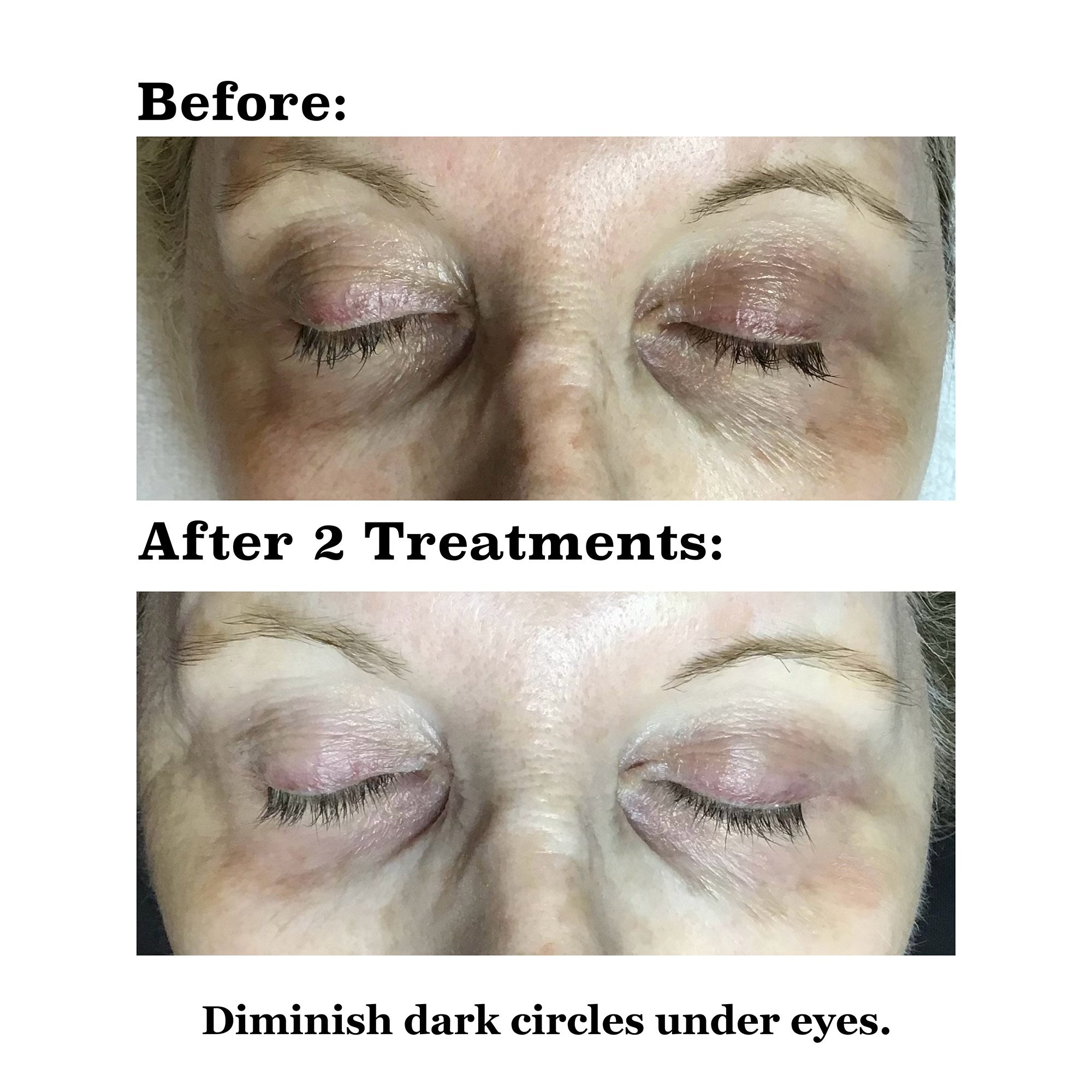 IPL medical spa treatment before and after