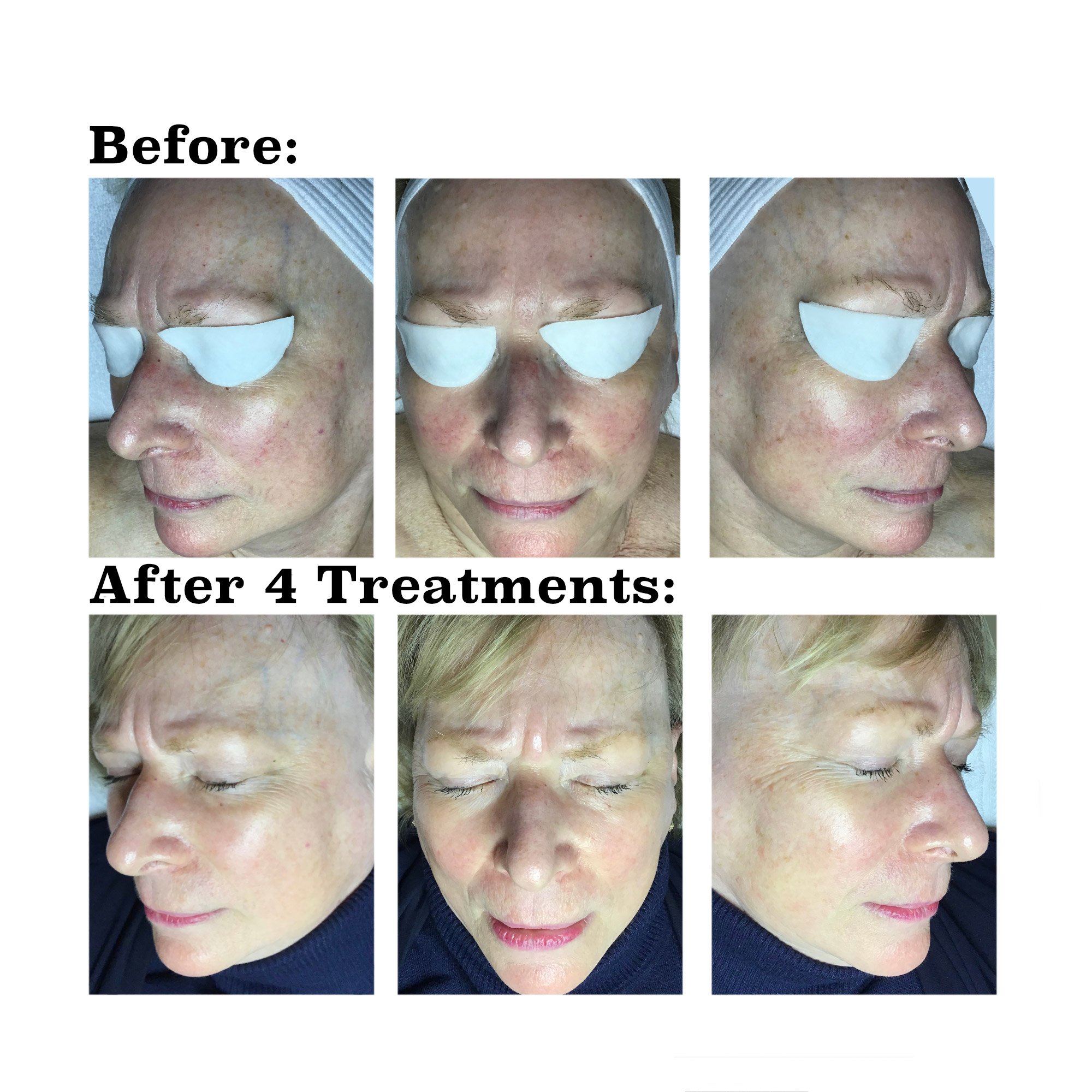 IPL medical spa treatment before and after