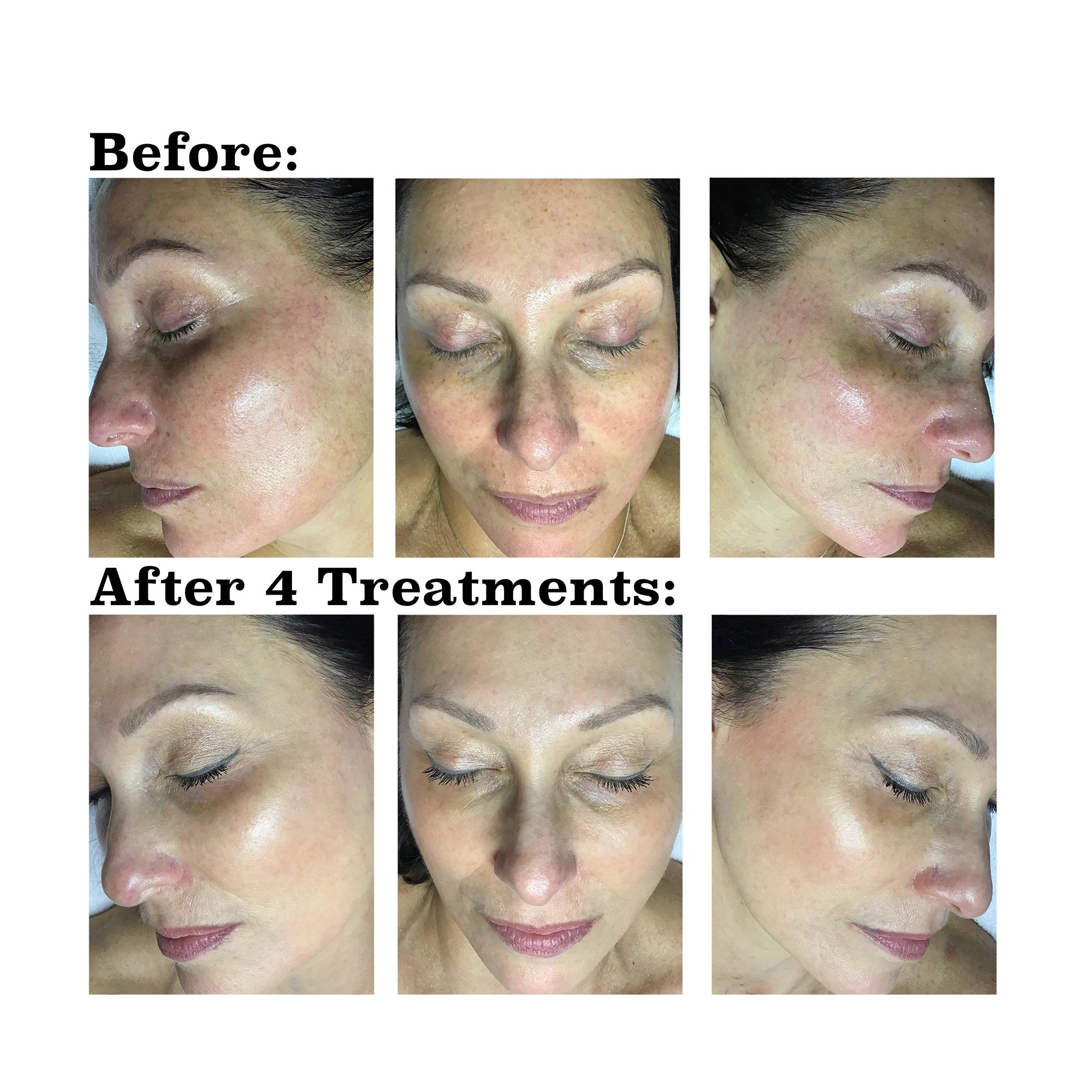 IPL medical spa treatment before and after