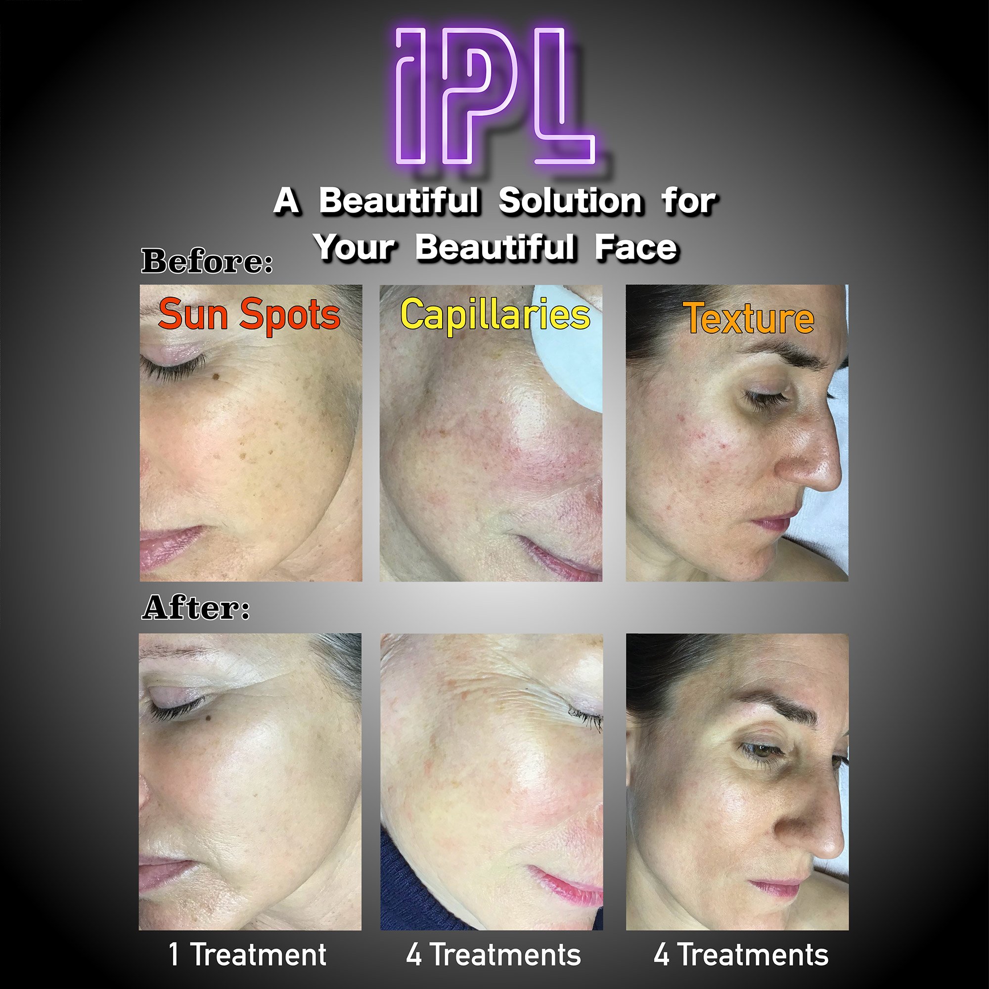 IPL medical spa treatment before and after