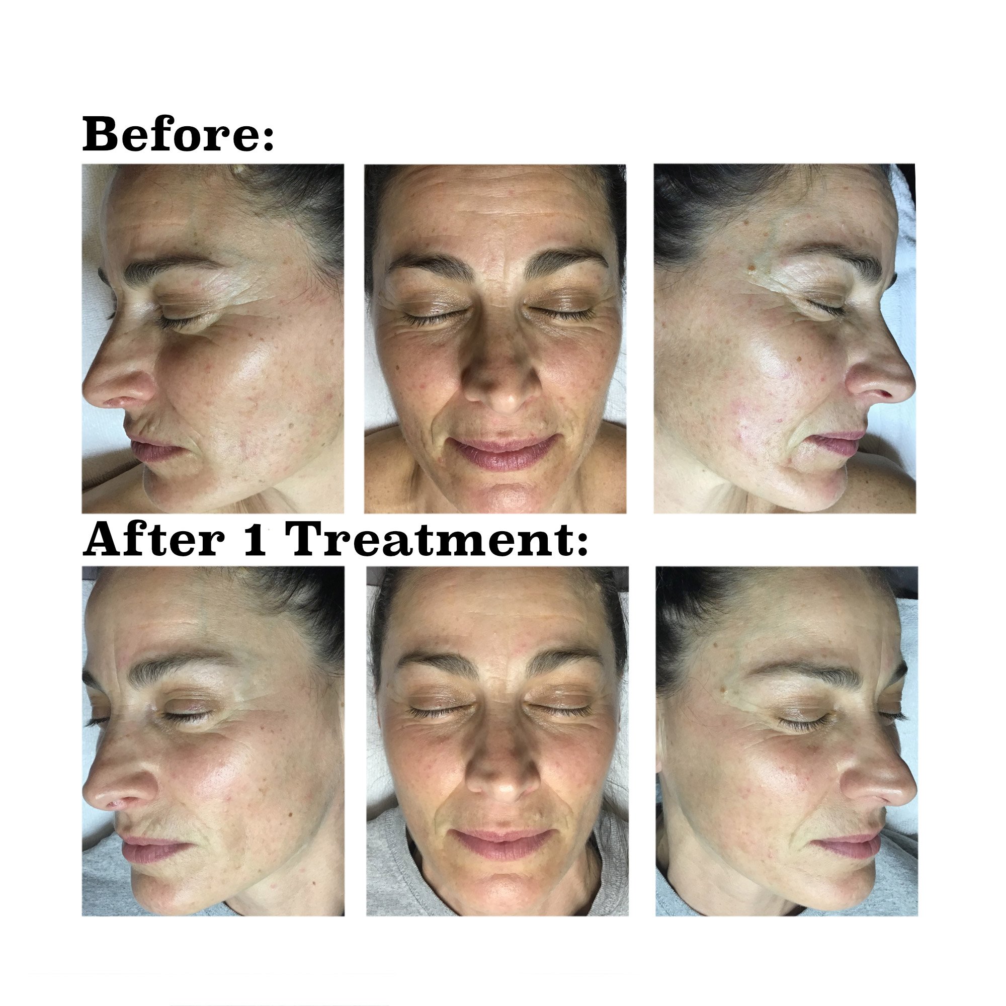 IPL medical spa treatment before and after