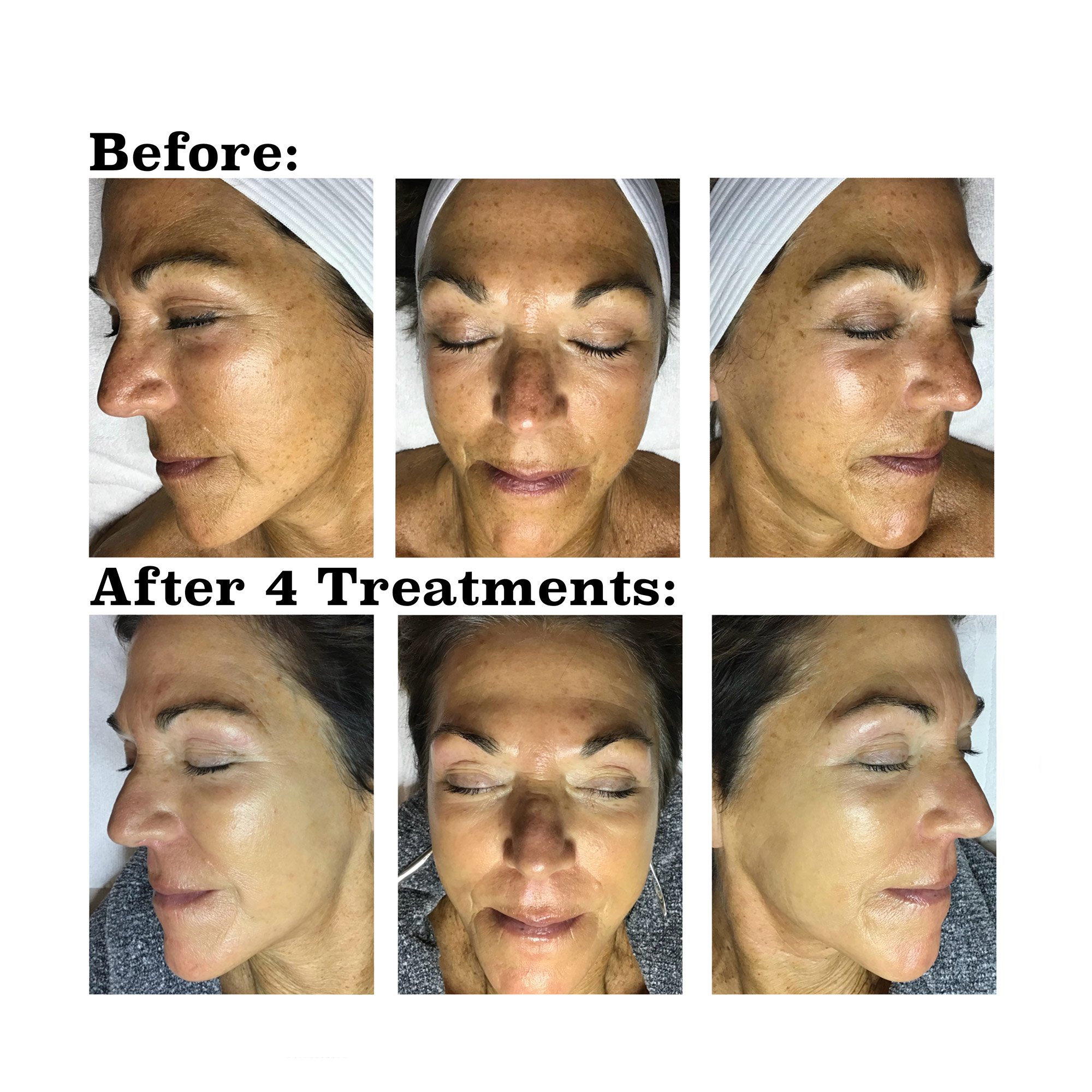 IPL medical spa treatment before and after