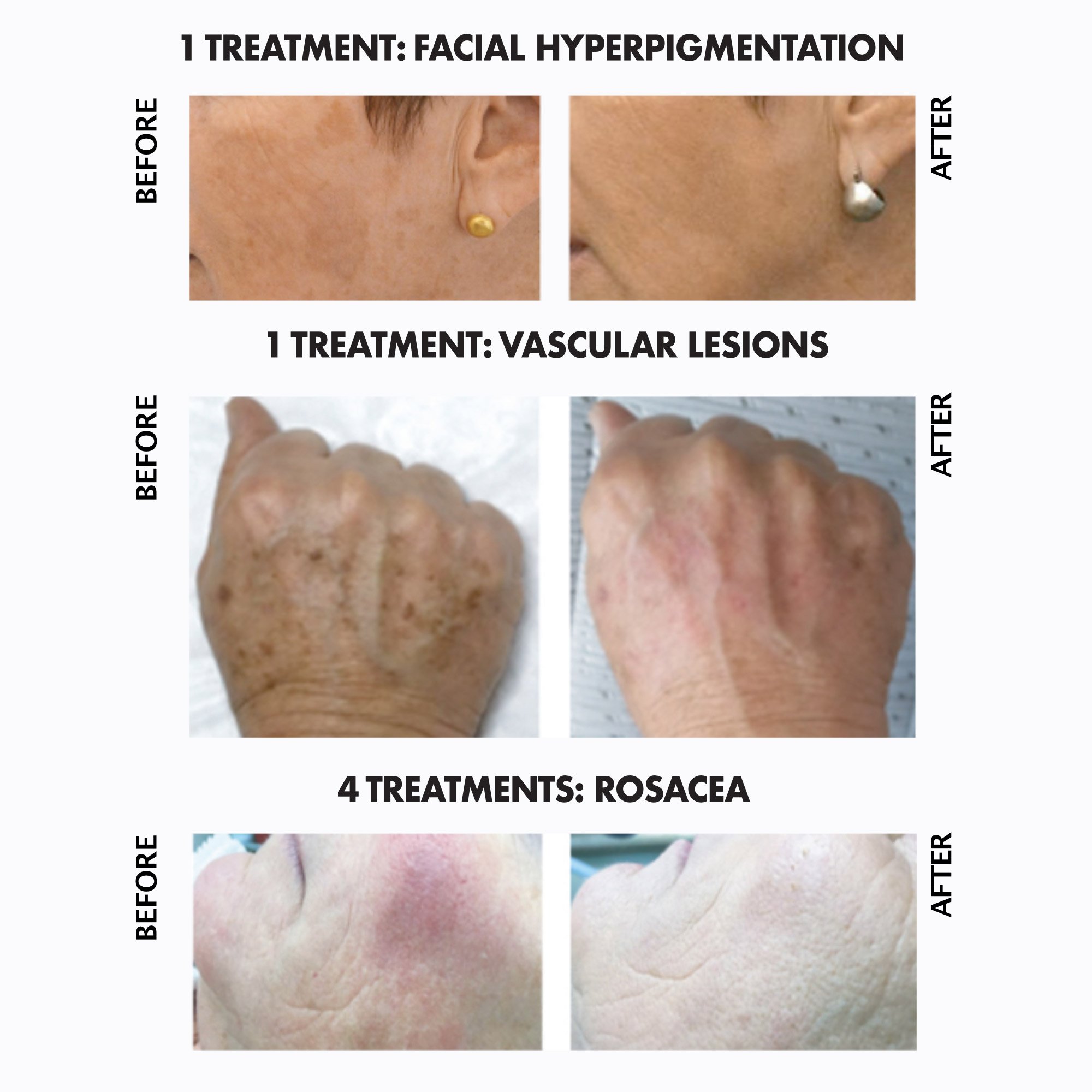 IPL medical spa treatment before and after