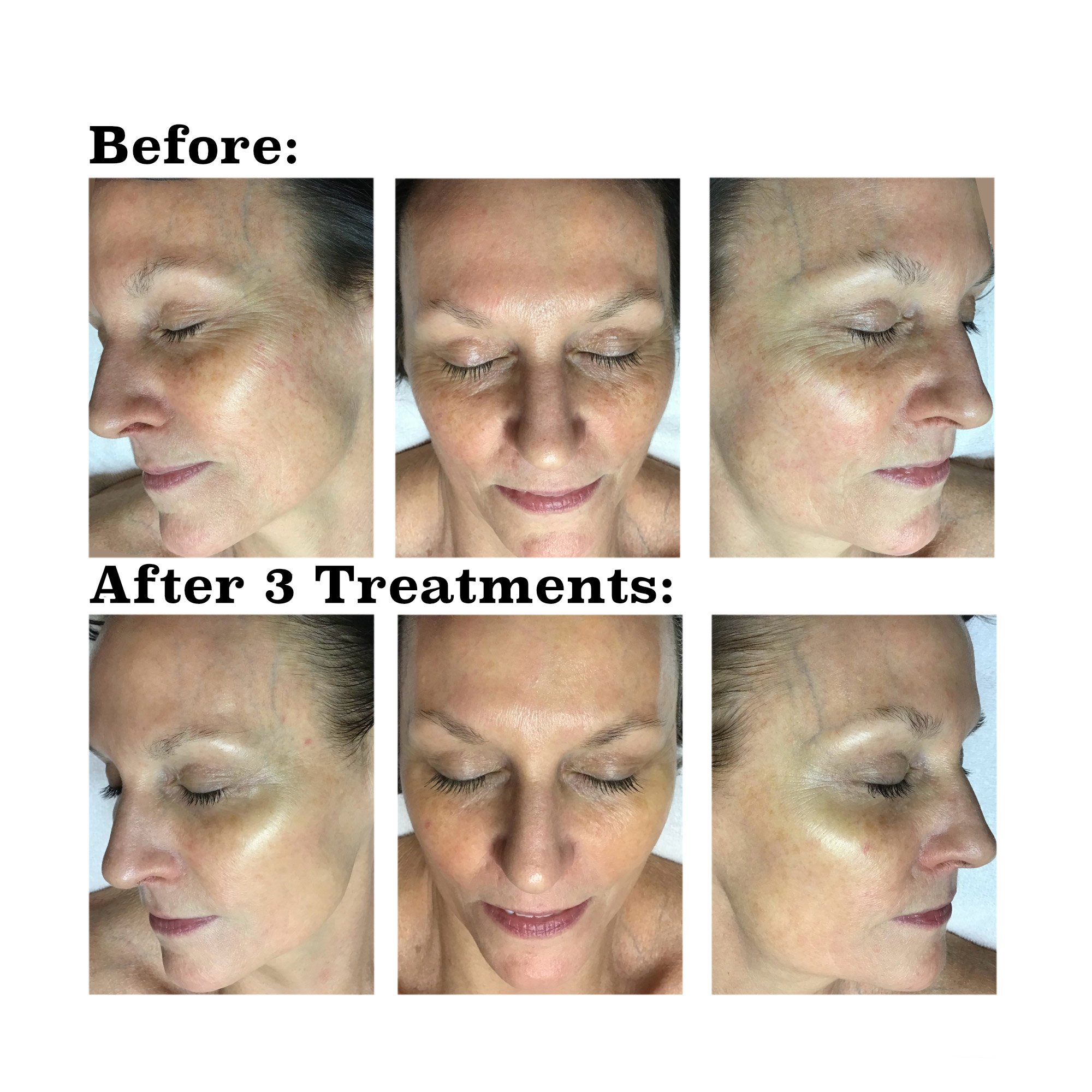 IPL medical spa treatment before and after