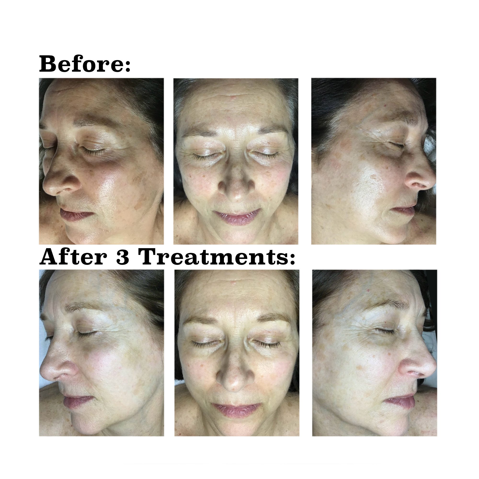 IPL medical spa treatment before and after