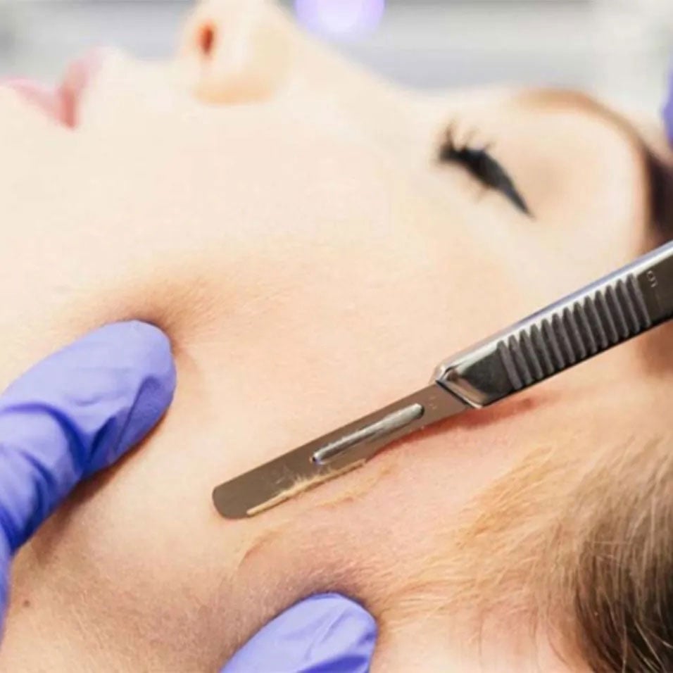 dermaplaning
